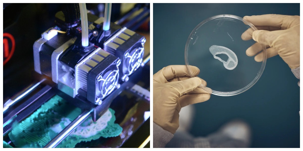 Медики из США впервые пересадили пациентке ухо, напечатанное на 3D-принтере (4 фото)