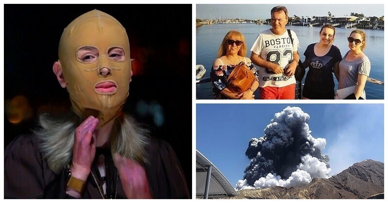 Обгоревшая во время извержения вулкана женщина показала своё лицо (9 фото + 2 видео)
